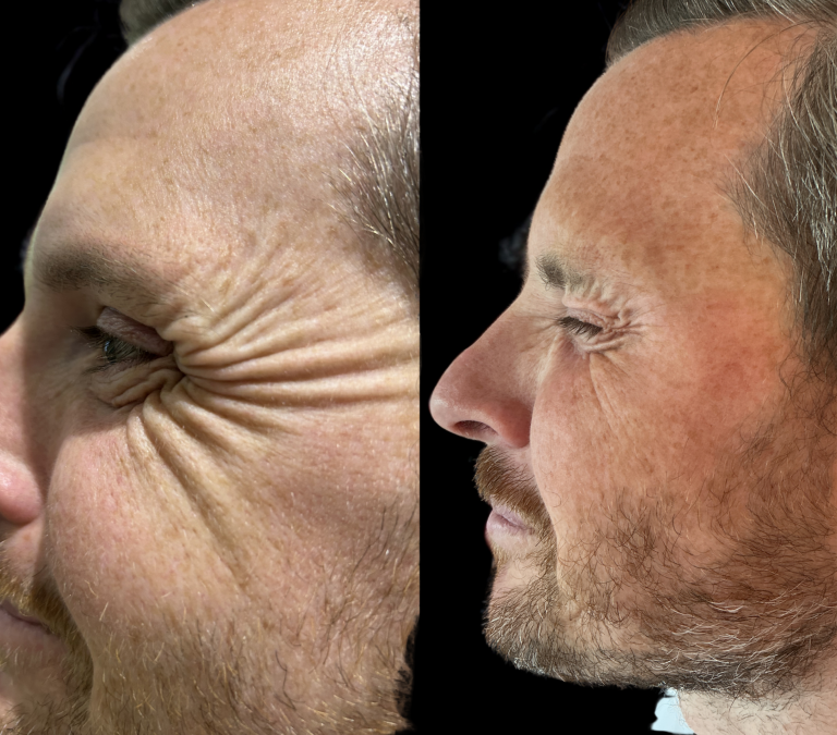 Botox crows feet before and after
