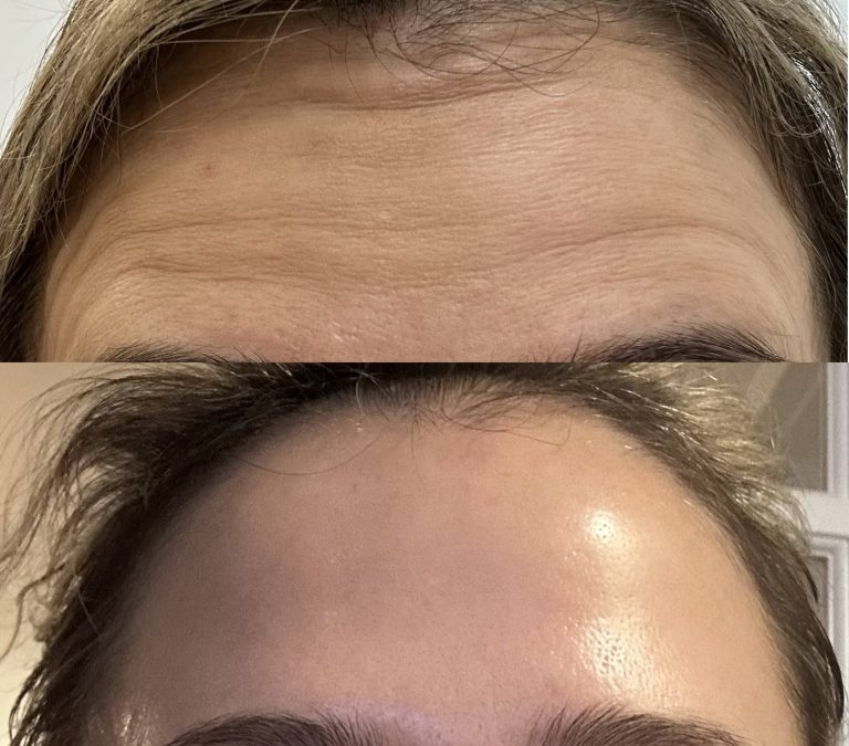 Before and after forehead Botox1