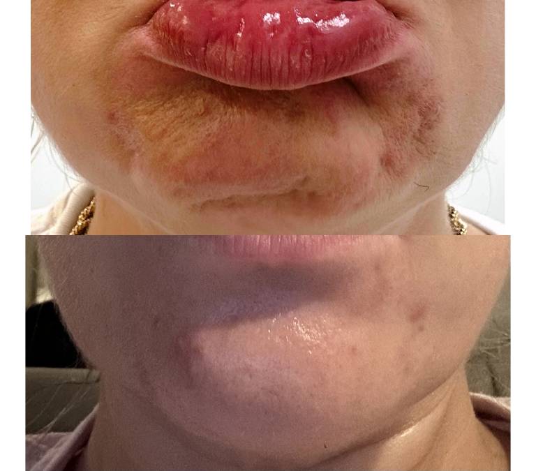 Pebble chin before and after1