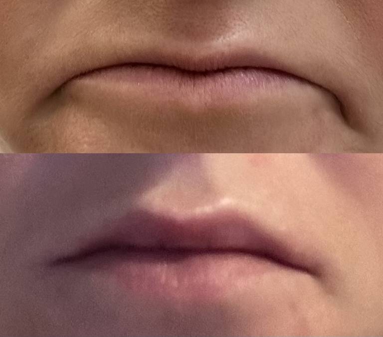 under eye rejuvenation treatment