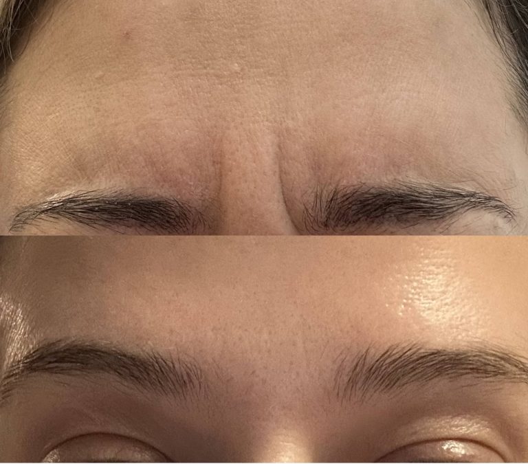 frown botox before and after 1
