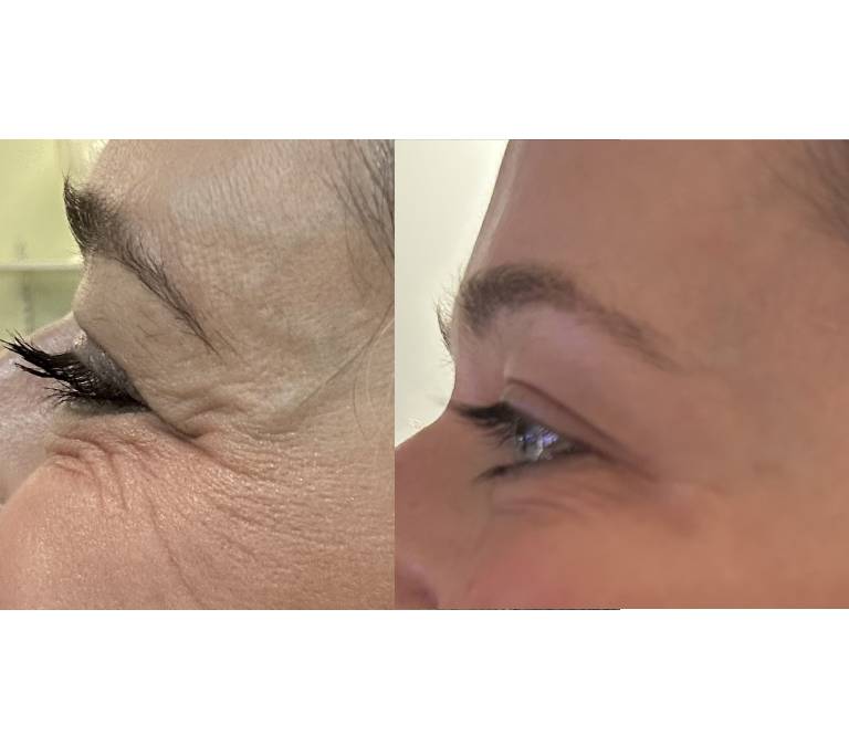 frown line before after 1