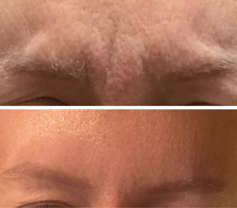 frown lines before after 1