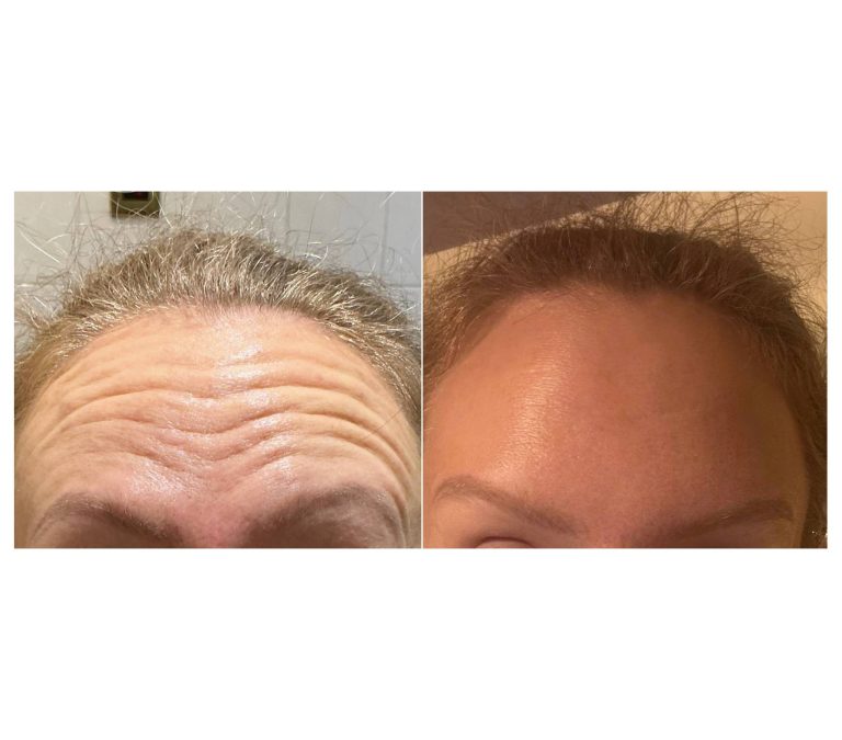 wrinkle before and after 11