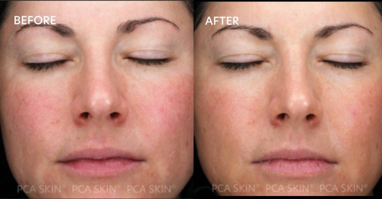 pca chemical peel near me in newcastle