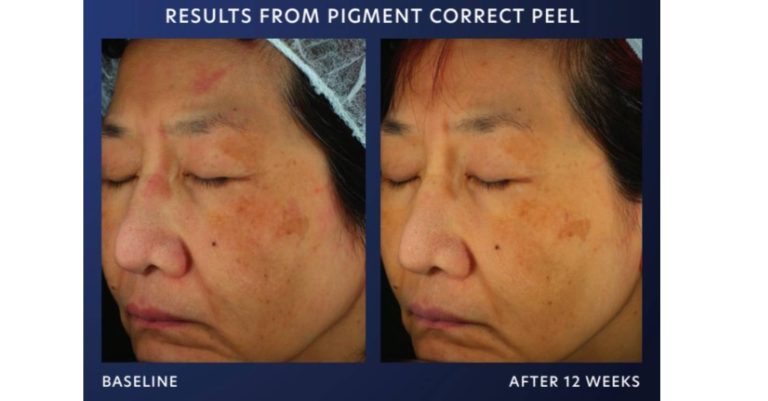 pca skin chemical peel in newcastle