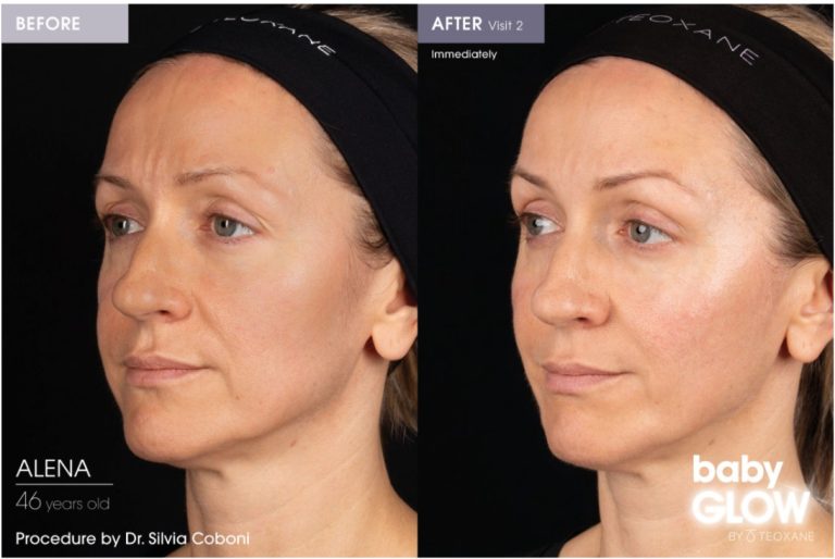 babyglow before after