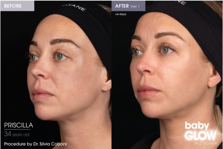 babyglow before after