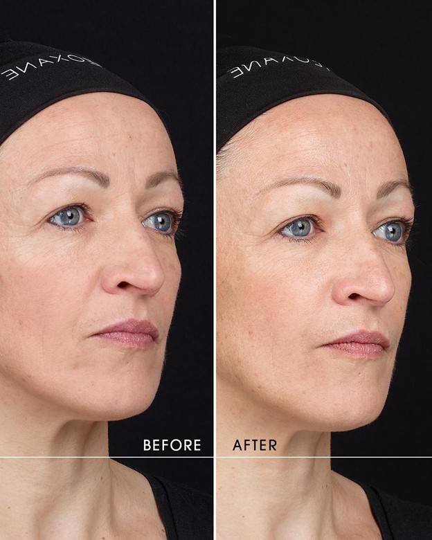 r-enerty before after 1