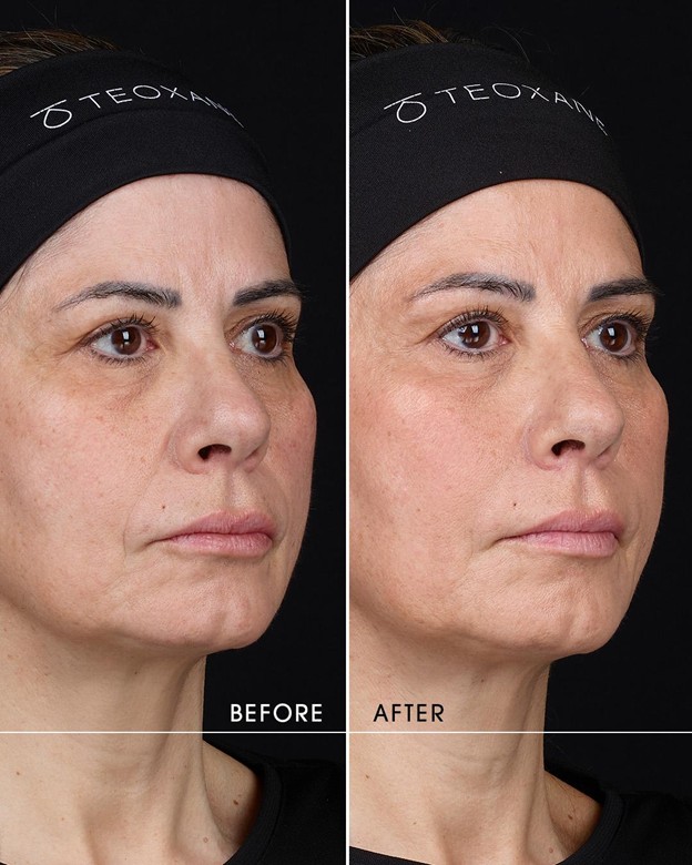 r-enerty before after 2