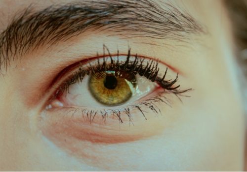 Why do my eyes look tired and what can we do about it?